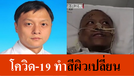 You are currently viewing รู้ยัง! โควิดไม่เพียงทำปอดเสียหาย แต่ยังอาจทำลายตับ ดูแลด่วน!!